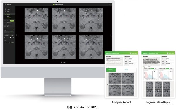 휴런, AI 기반 파킨슨병 선별 기술의 경제성 입증...국제 학술지 게재 - 뉴스 썸네일 이미지